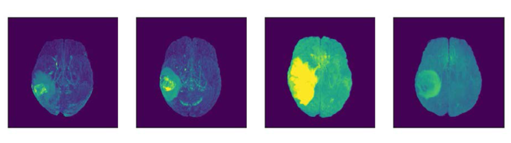 MRI scans with brain tumor on left cortex