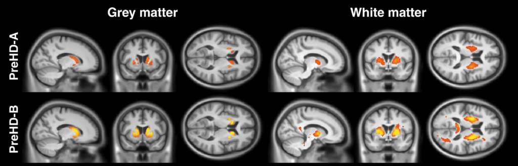 MRI brain scan - Huntington's